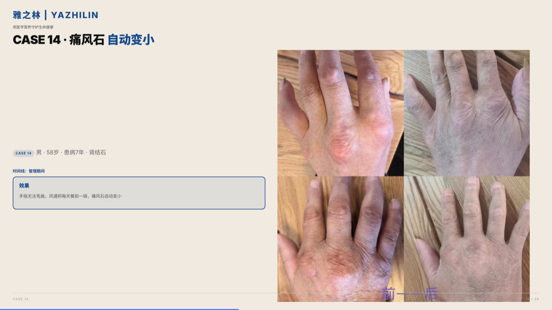 雅之林 痛风高尿酸 案例分析 第16页