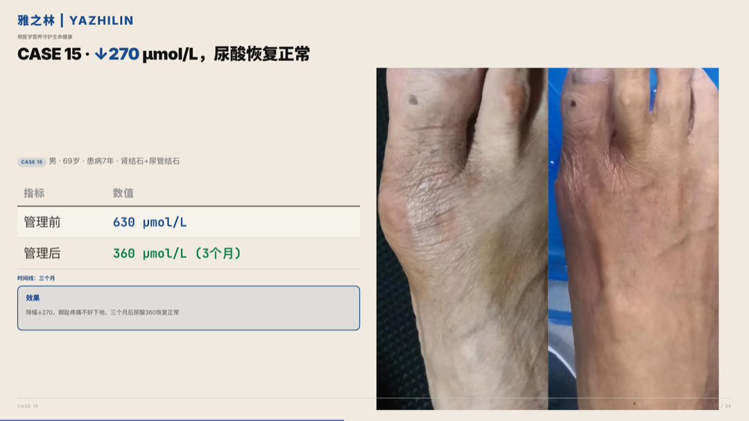 雅之林 痛风高尿酸 案例分析 第17页