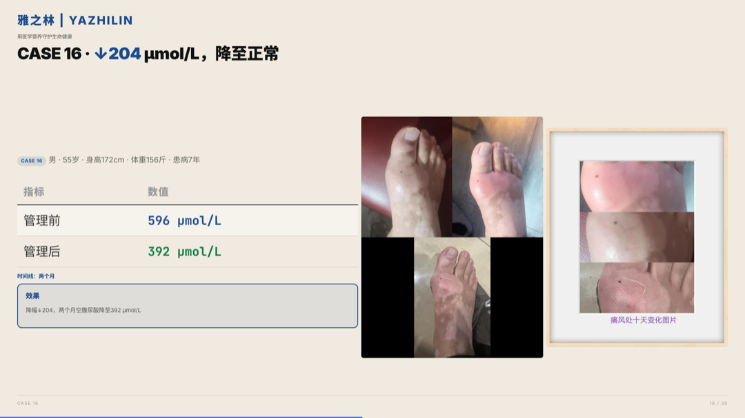 雅之林 痛风高尿酸 案例分析 第18页