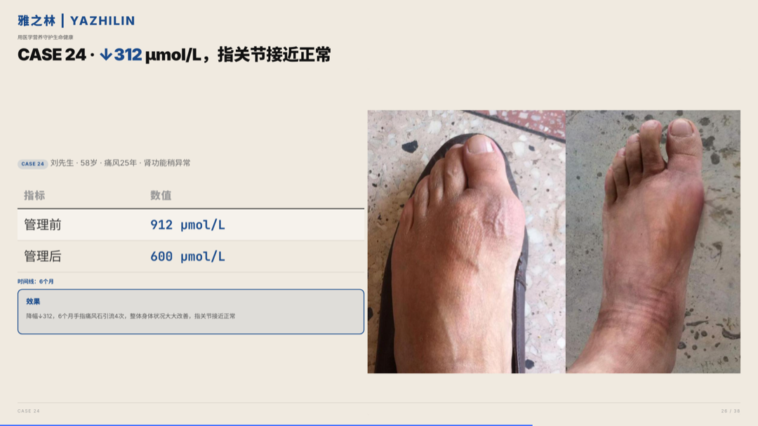 雅之林 痛风高尿酸 案例分析 第26页
