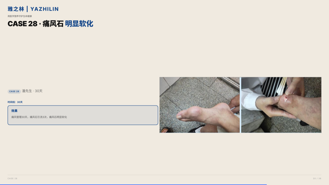 雅之林 痛风高尿酸 案例分析 第30页