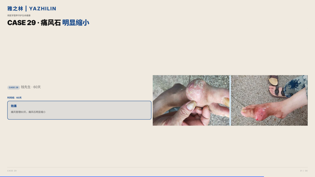 雅之林 痛风高尿酸 案例分析 第31页