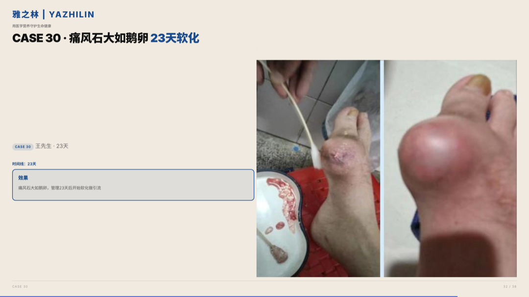 雅之林 痛风高尿酸 案例分析 第32页